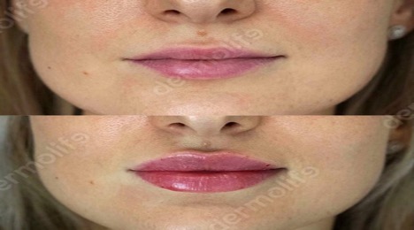 Consultation for a popular aesthetic treatment